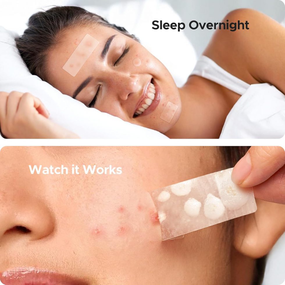 Large Pimple Patches for Face & Body Zit Breakouts (126 Count)