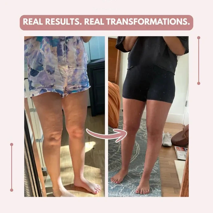 3D legging - say goodbye to lipedema pain and swelling naturally