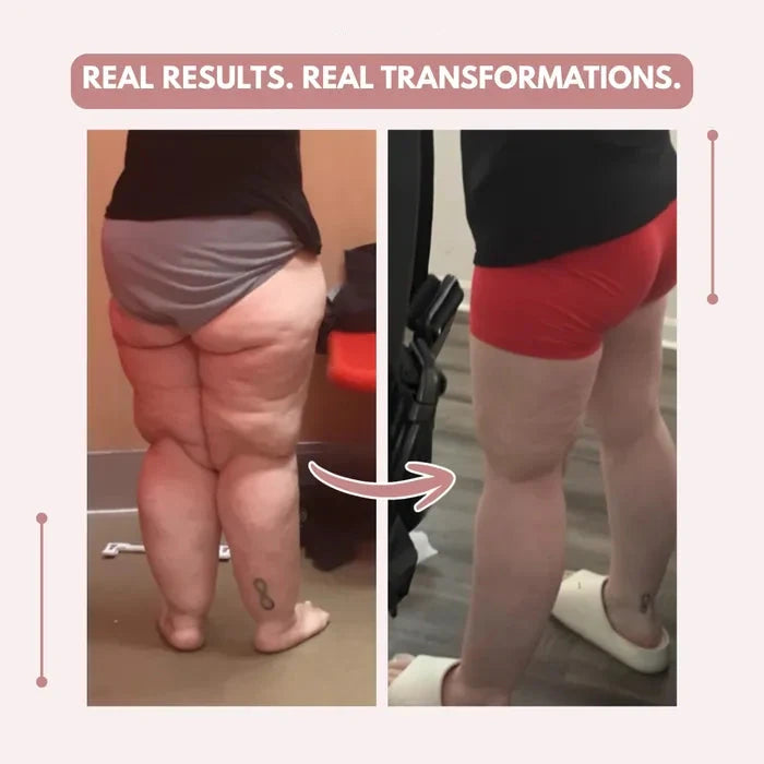 3D legging - say goodbye to lipedema pain and swelling naturally