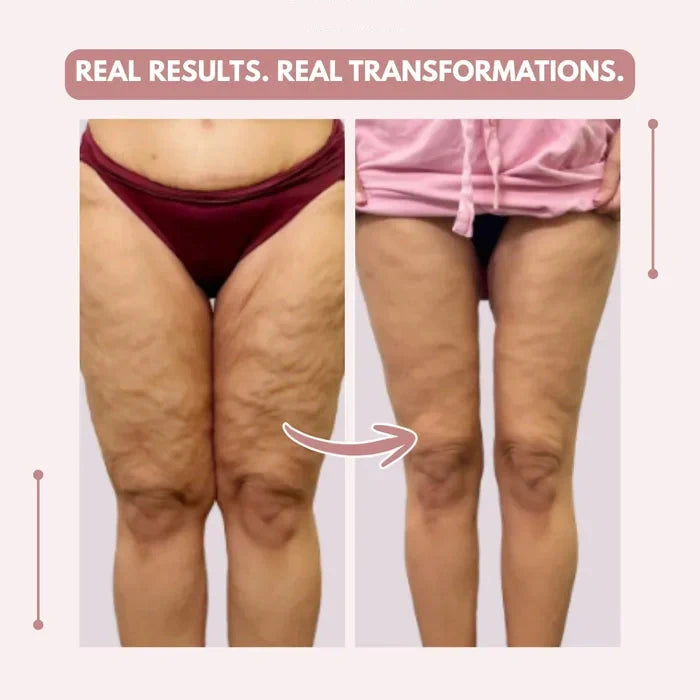 3D legging - say goodbye to lipedema pain and swelling naturally