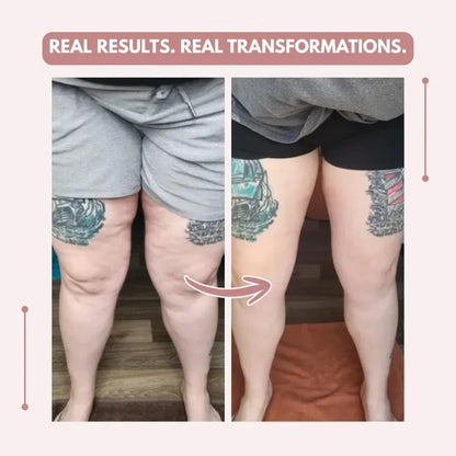 3D legging - say goodbye to lipedema pain and swelling naturally